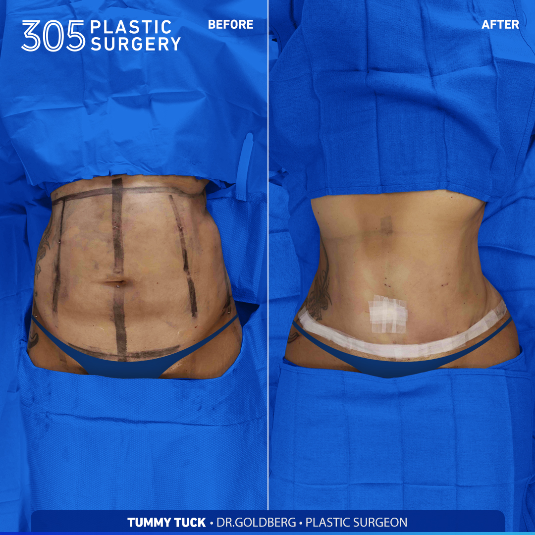 Tummy Tuck Gallery - 305 Plastic Surgery