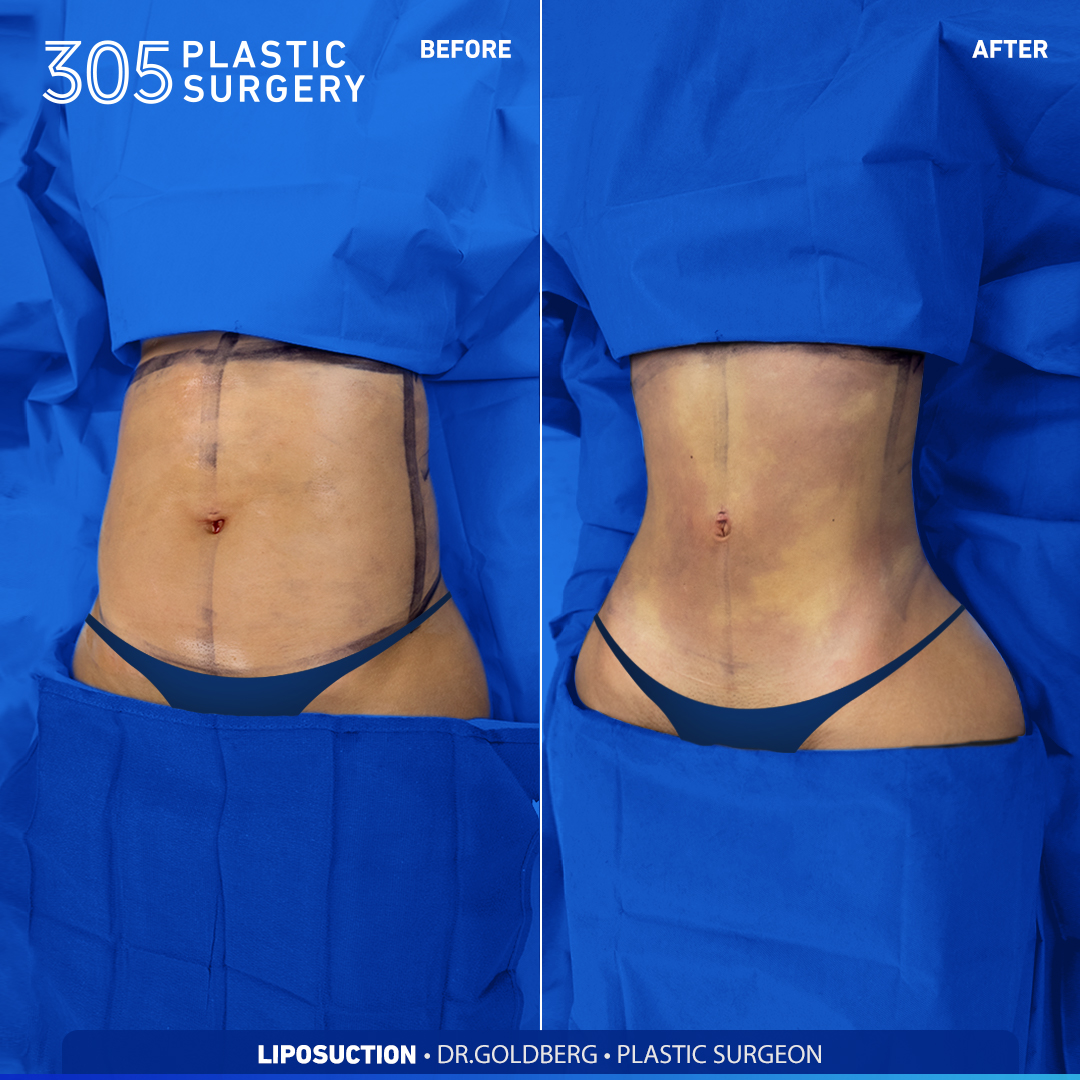 Liposuction Gallery - 305 Plastic Surgery