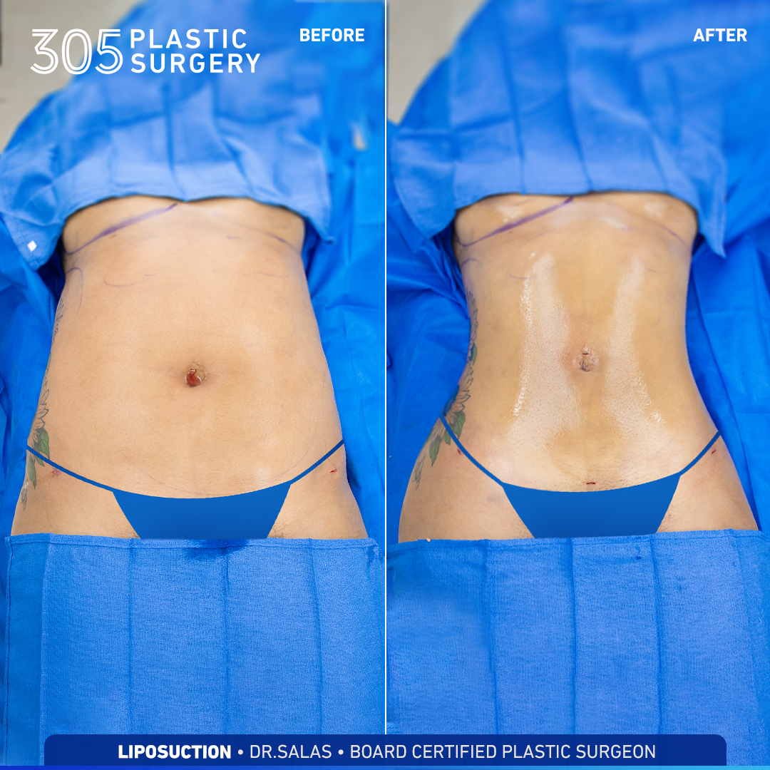 Liposuction Gallery - 305 Plastic Surgery