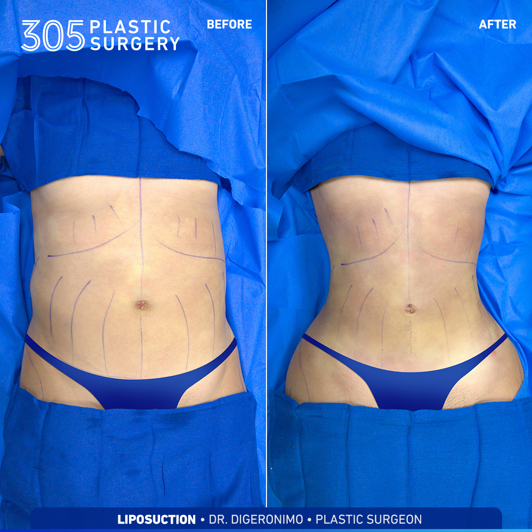 LIPOSUCTION B&A - 305 Plastic Surgery