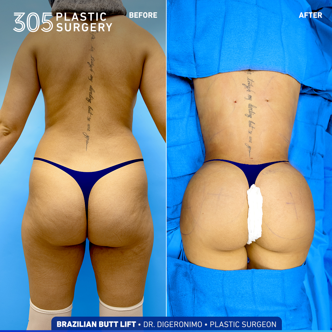 BRAZILIAN BUTT LIFT B&A - 305 Plastic Surgery
