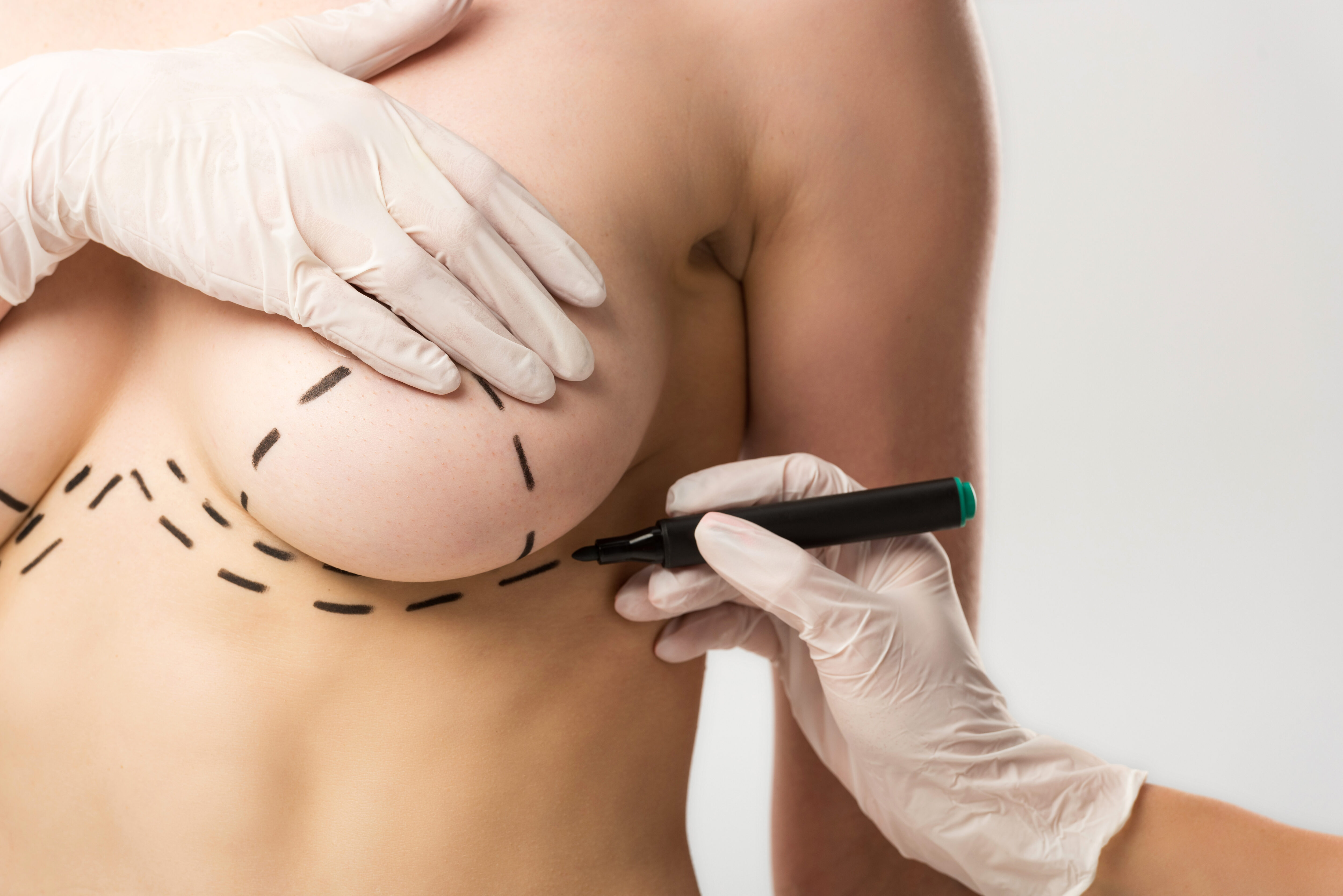 surgical marks on breast for augmentation