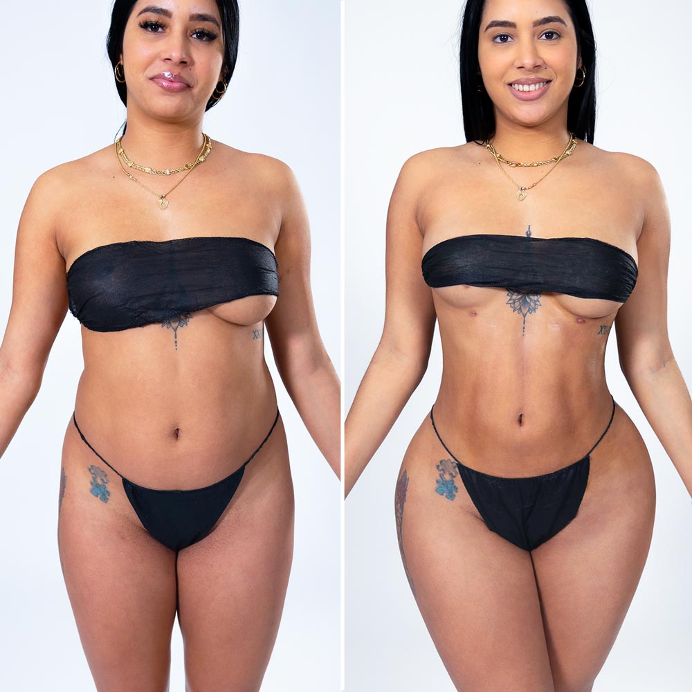 before and after brazilian butt lift results