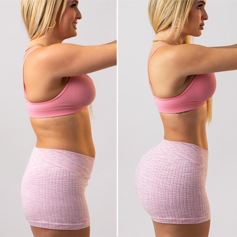 before and after comparison of brazilian butt lift