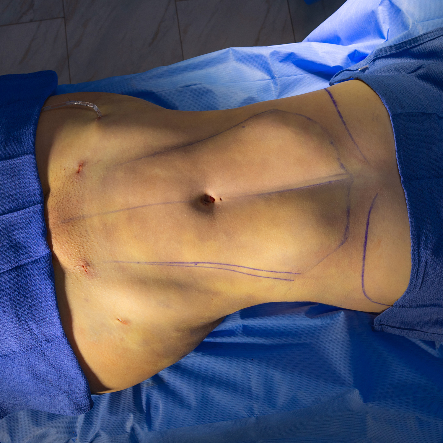 abdominal liposuction after