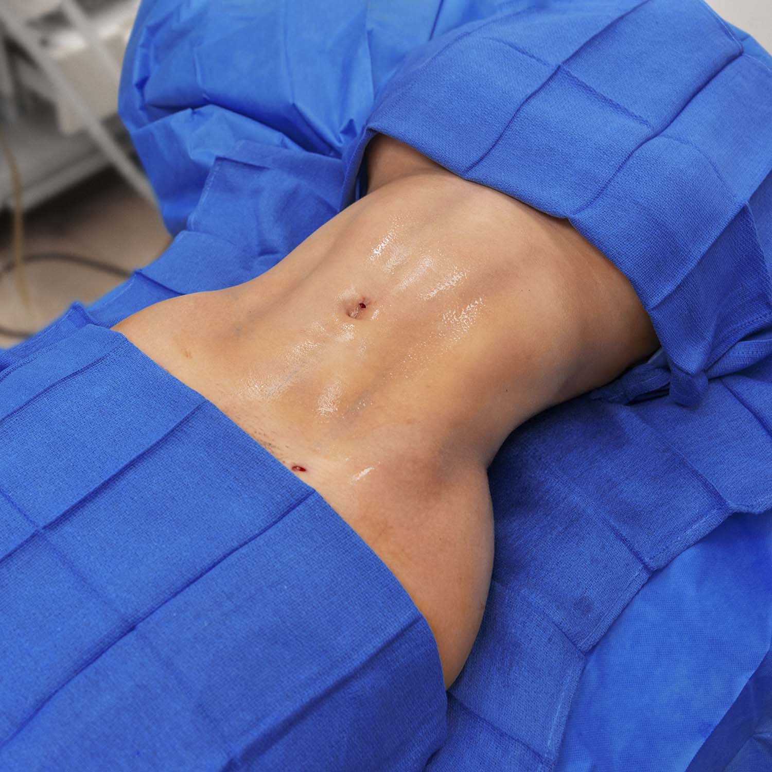 after abdominal hd lipo