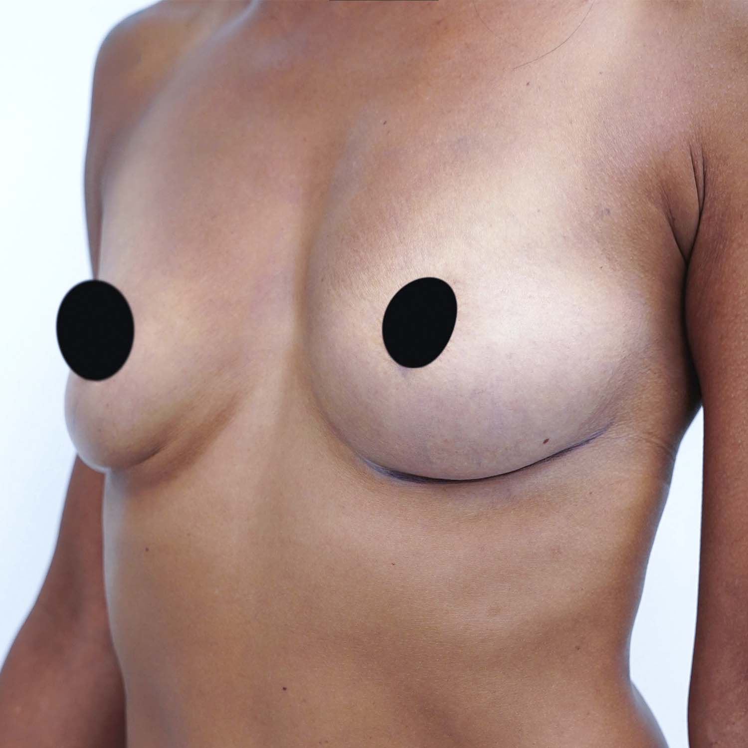 breast augmentation before