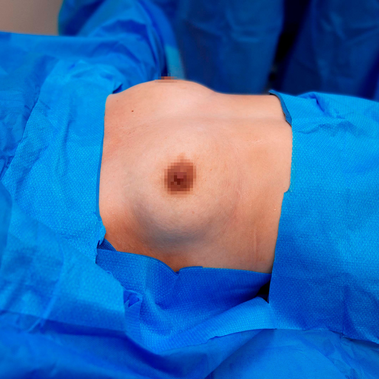 breast augmentation digeronimo patient before