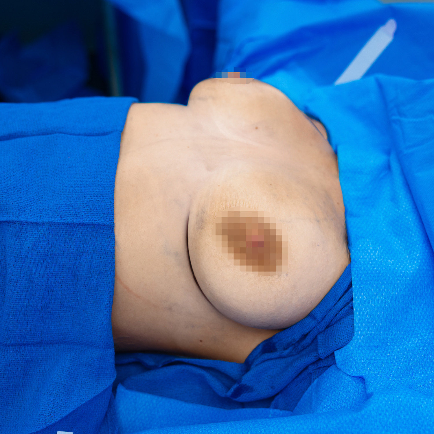 breast lift procedure before