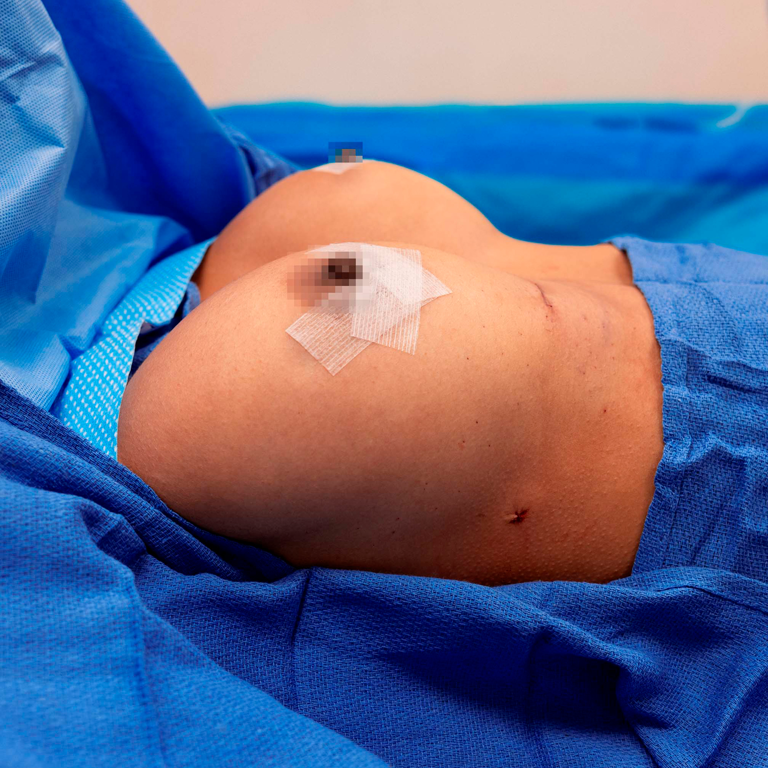 digeronimo patient after breast augmentation