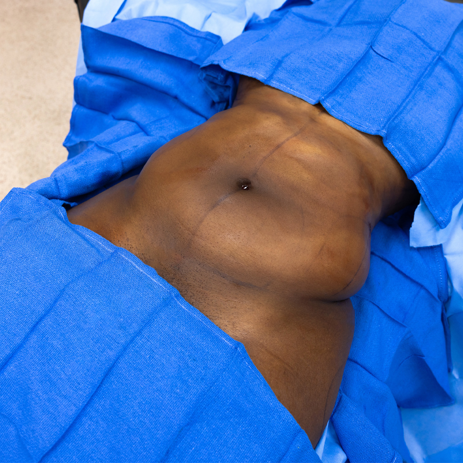 digeronimo patient before liposuction