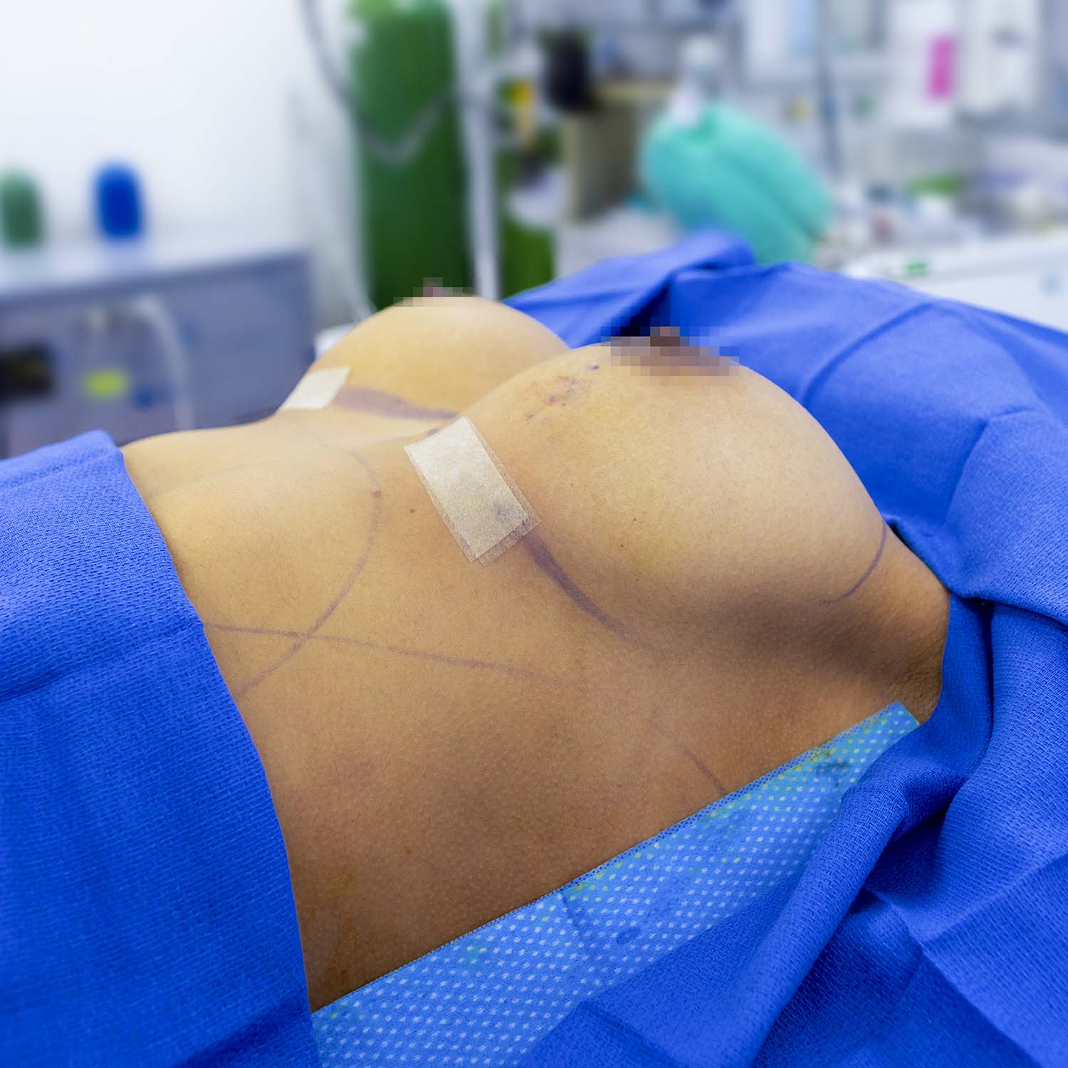 doctor nosrati breast augmentation after