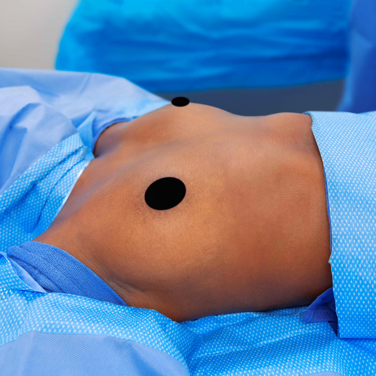 dr bazell patient breast augmentation before