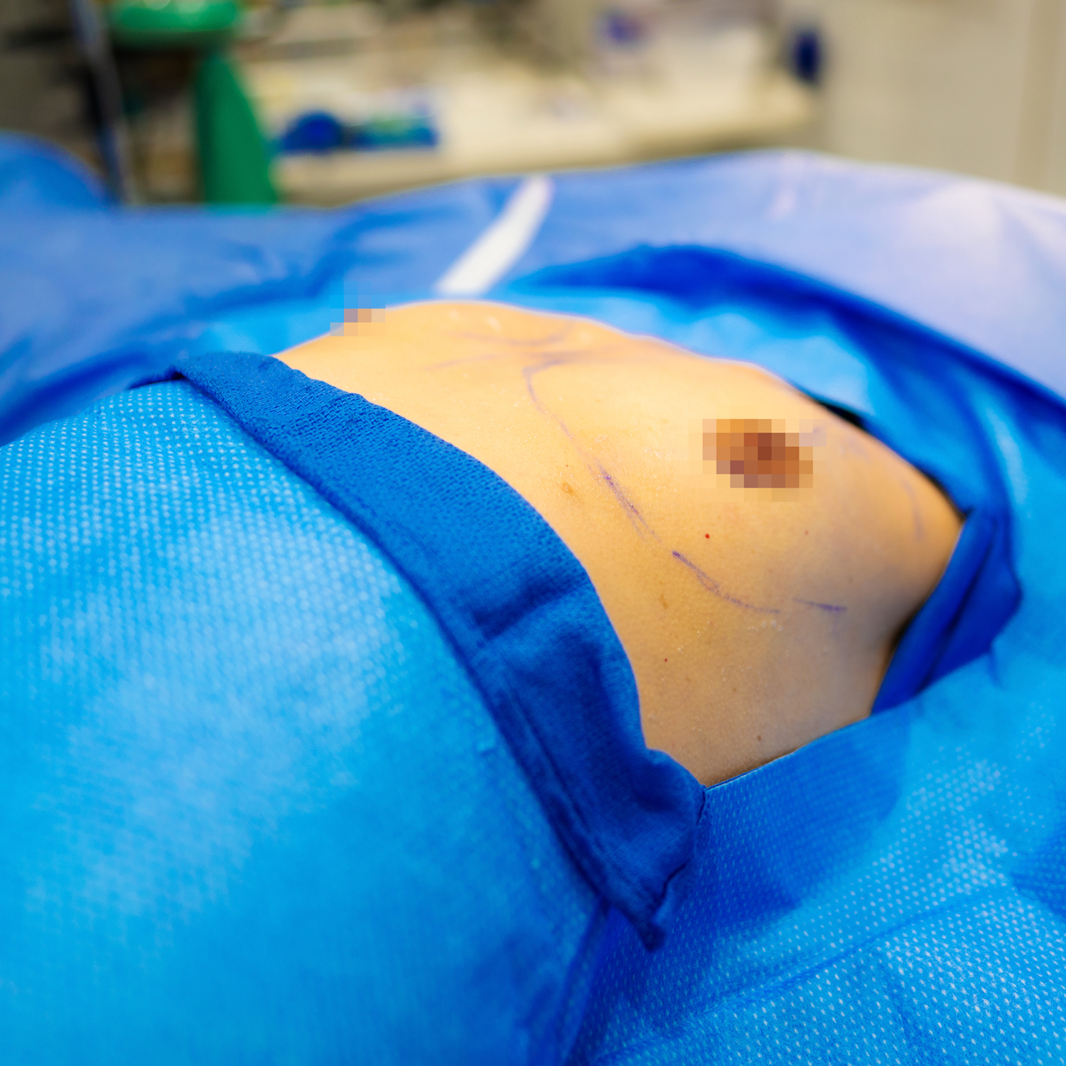 dr brewster patient before breast augmentation