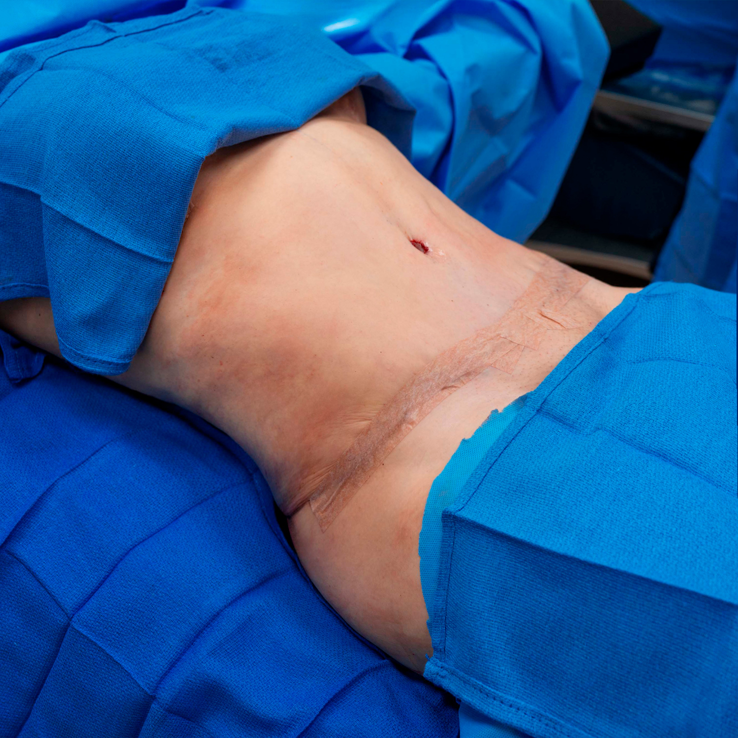 dr digeronimo tummy tuck after