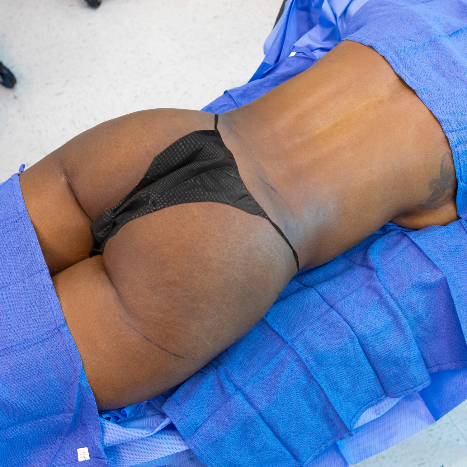 dr manny brazilian butt lift before