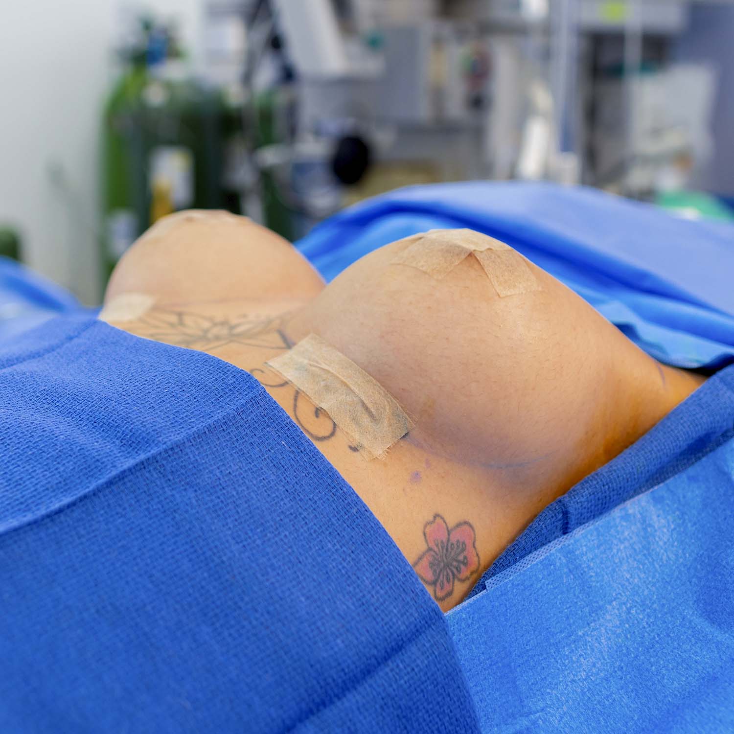 dr nosrati breast augmentation after