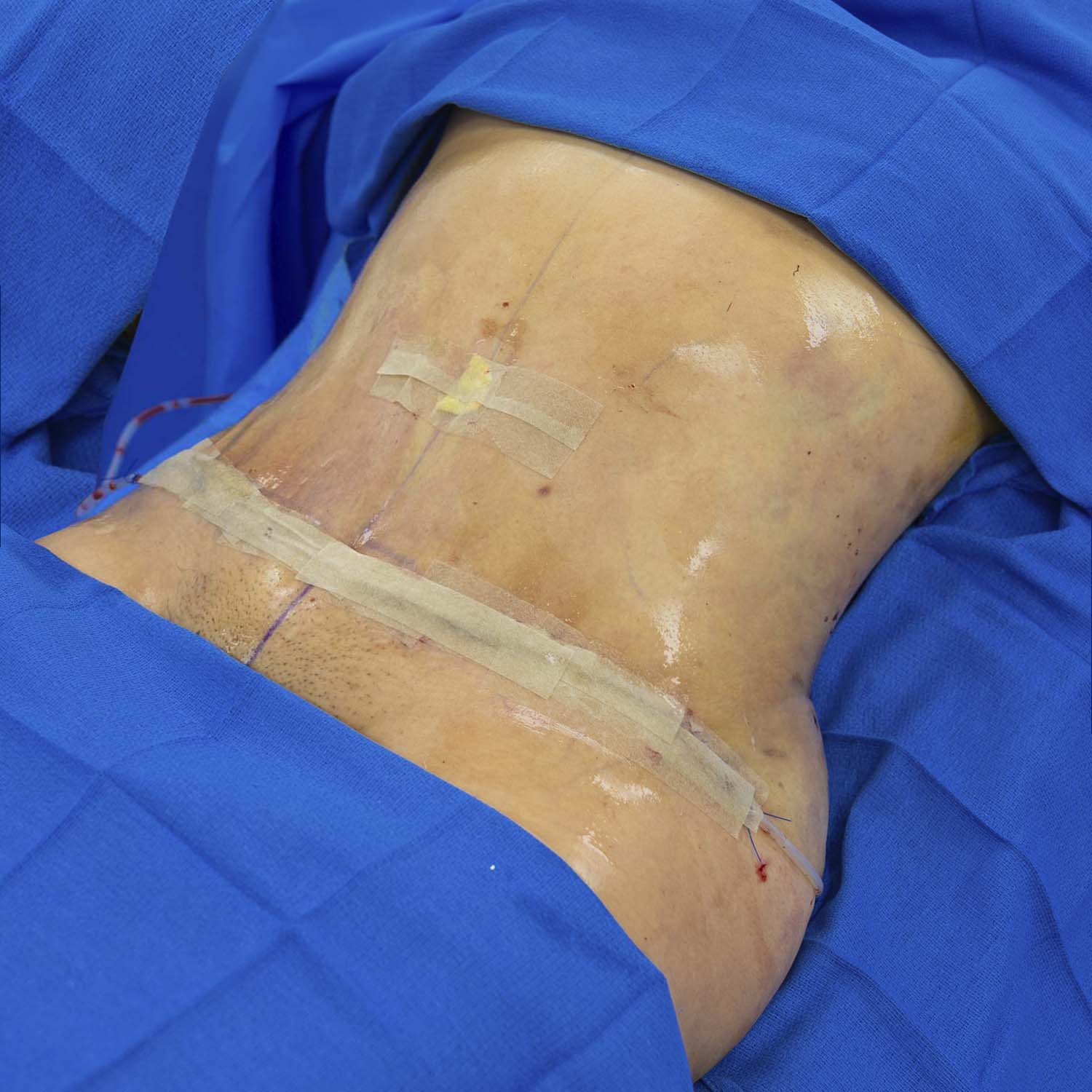 dr nosrati patient tummy tuck after