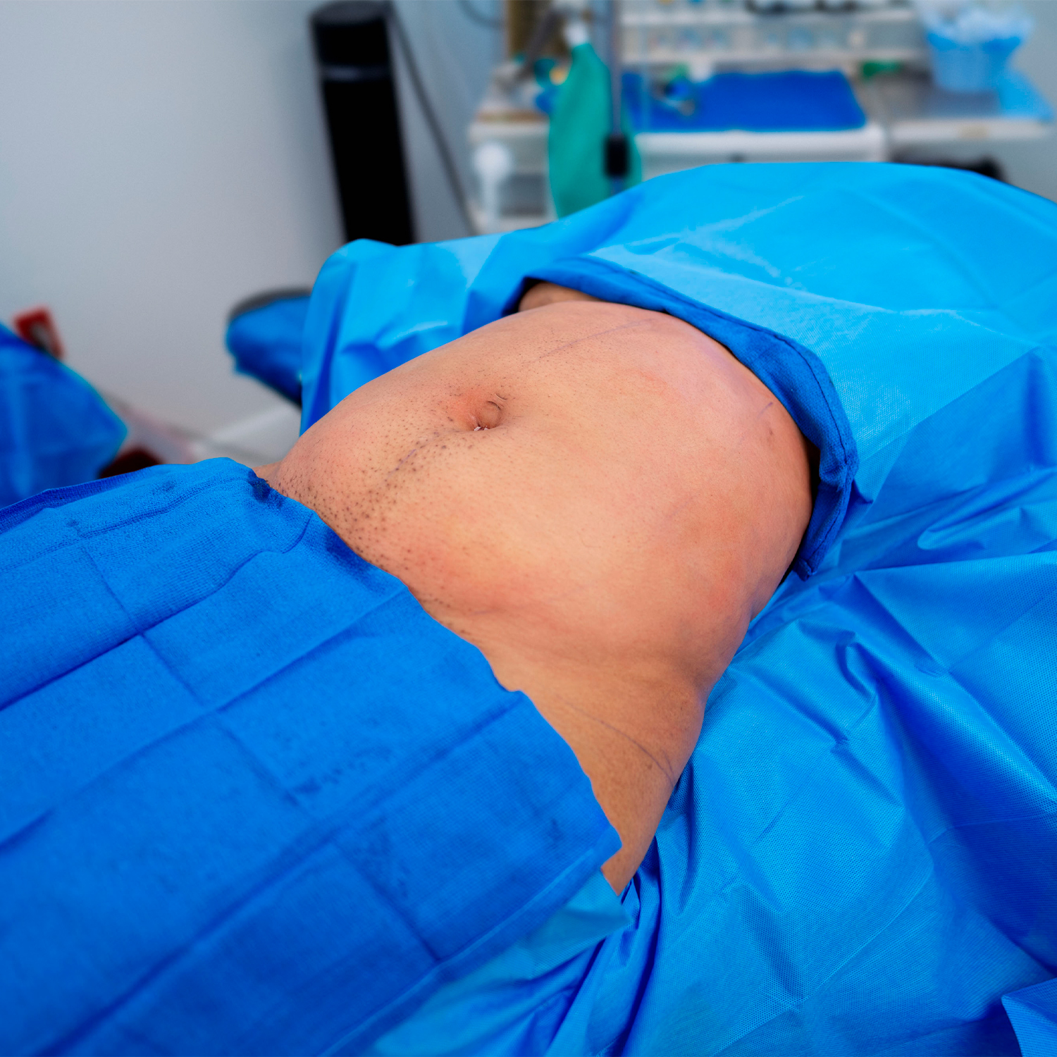 dr. brewster patient before liposuction