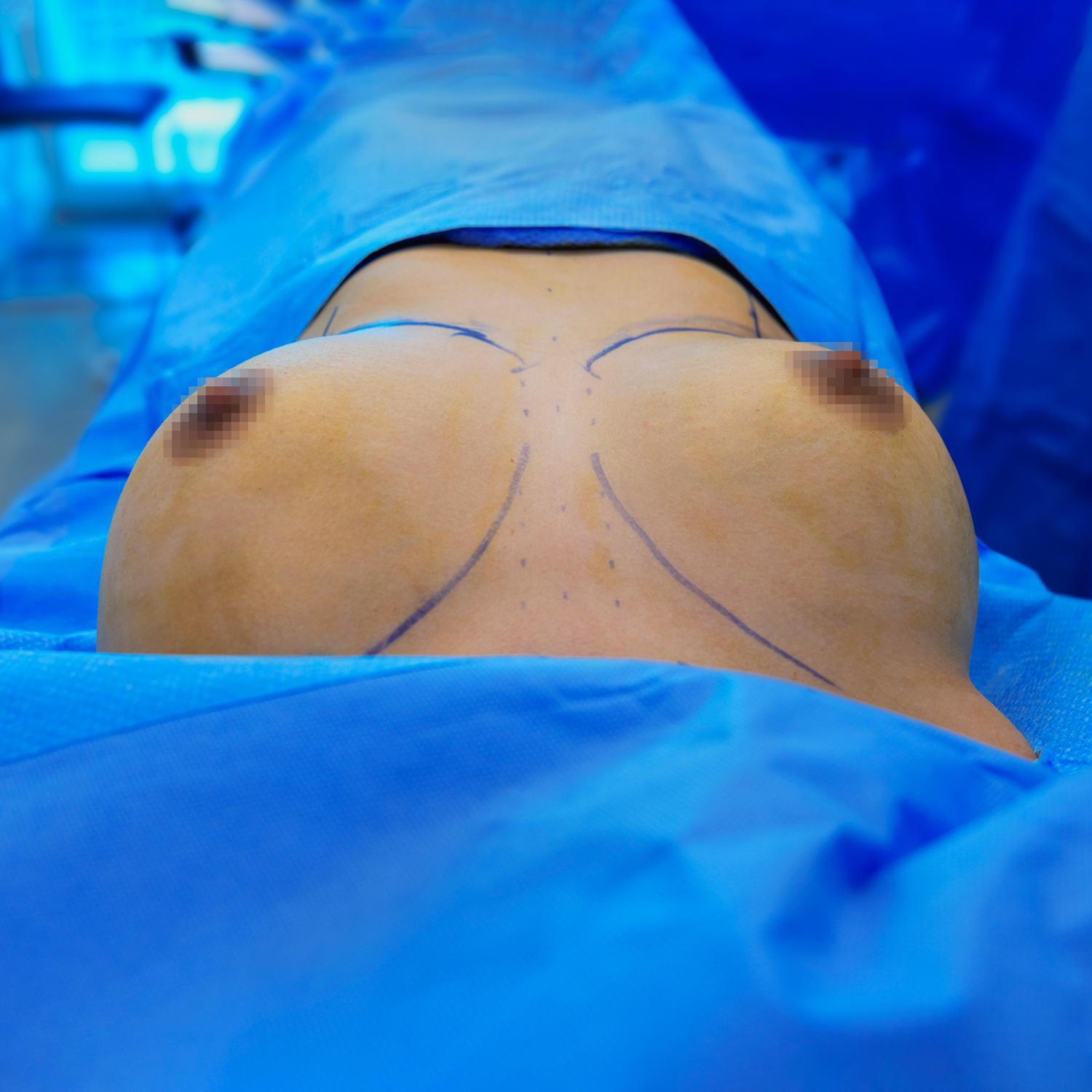 jc alvarez breast augmentation before