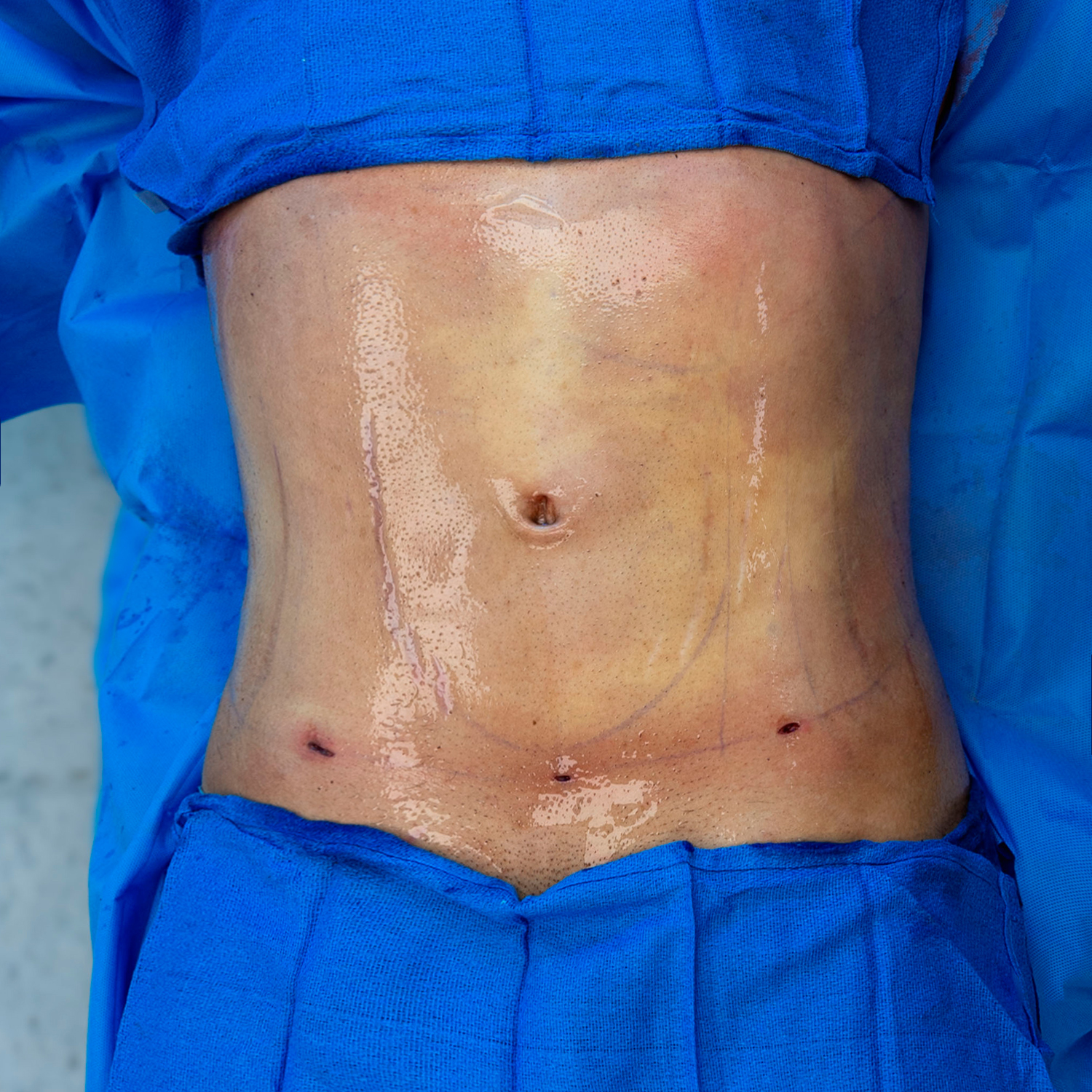 jc alvarez male liposuction after