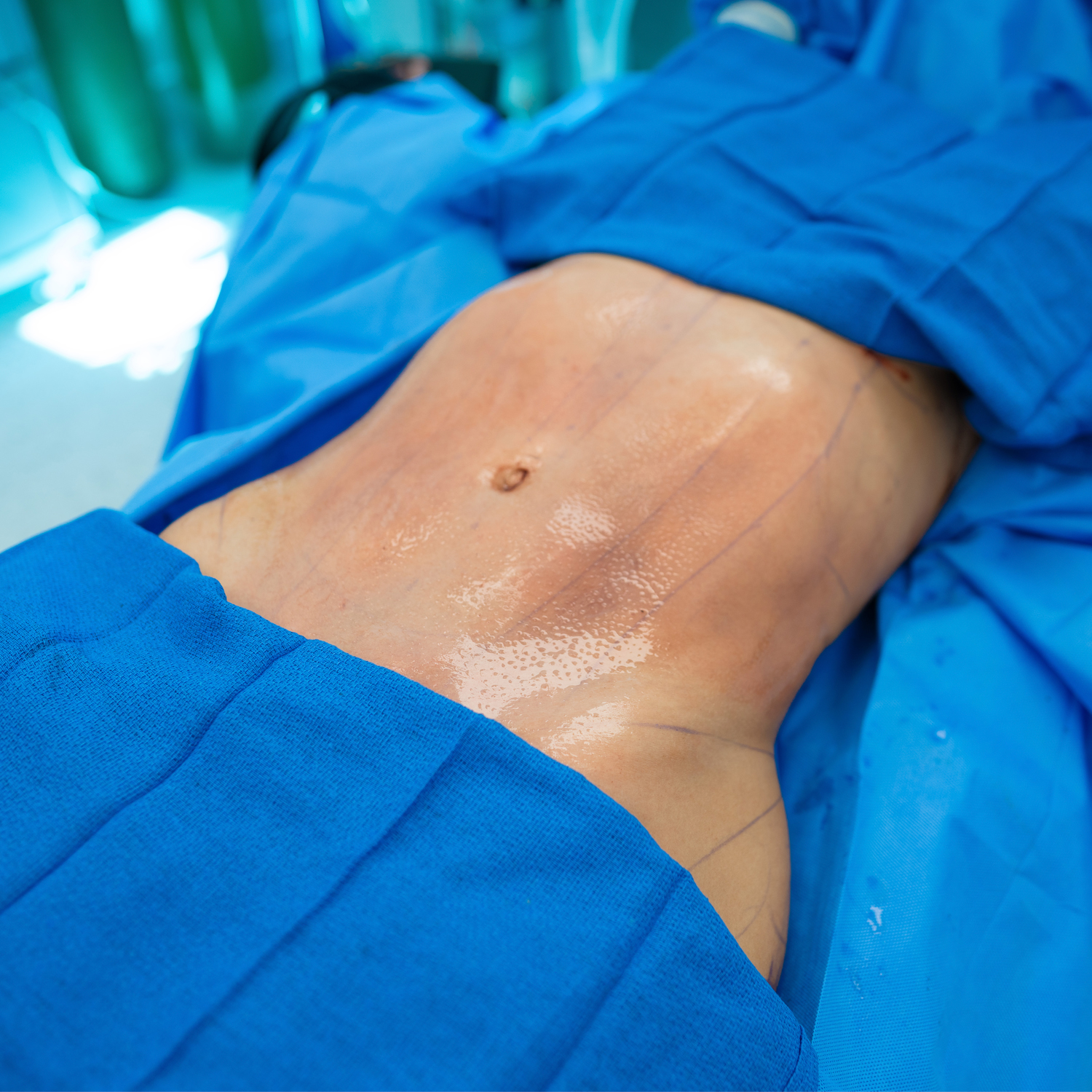 liposuction after