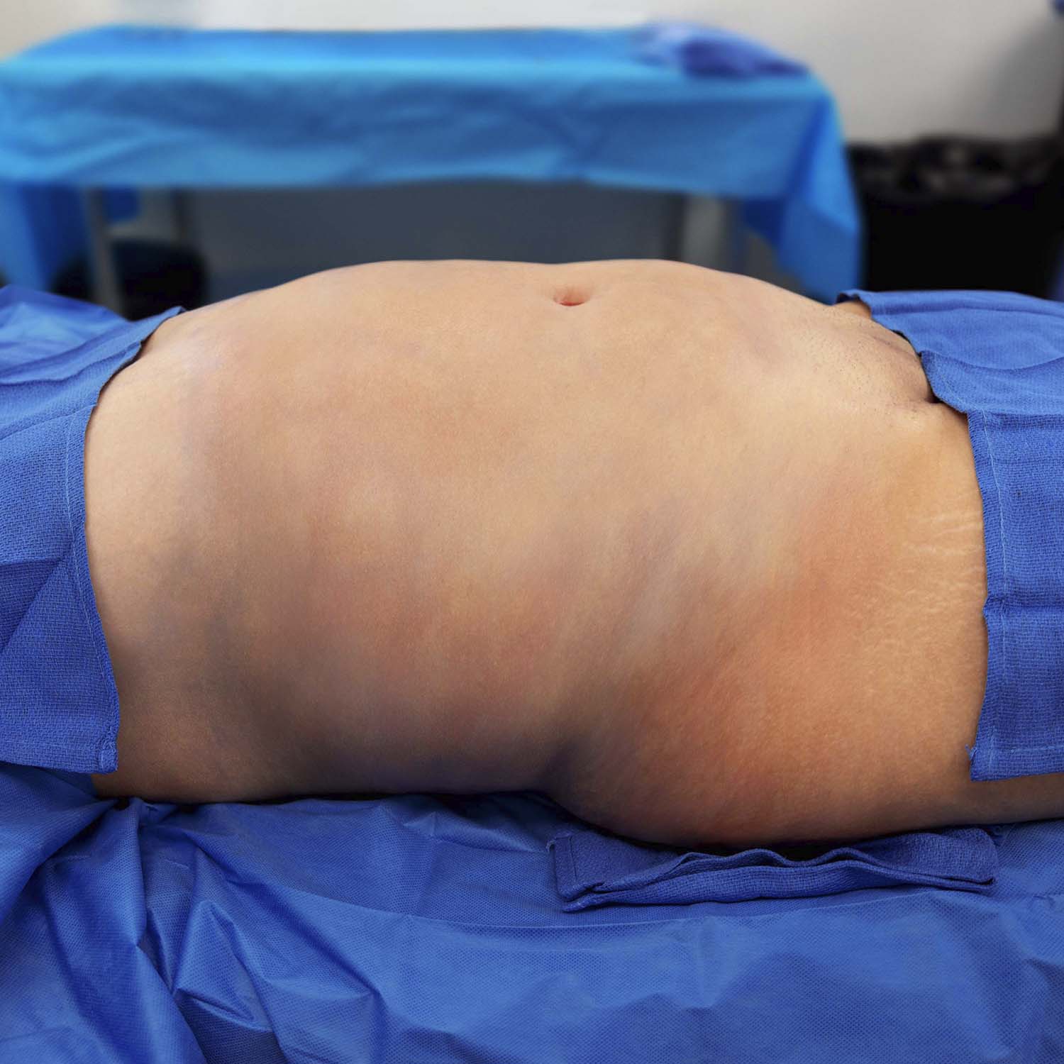 liposuction before