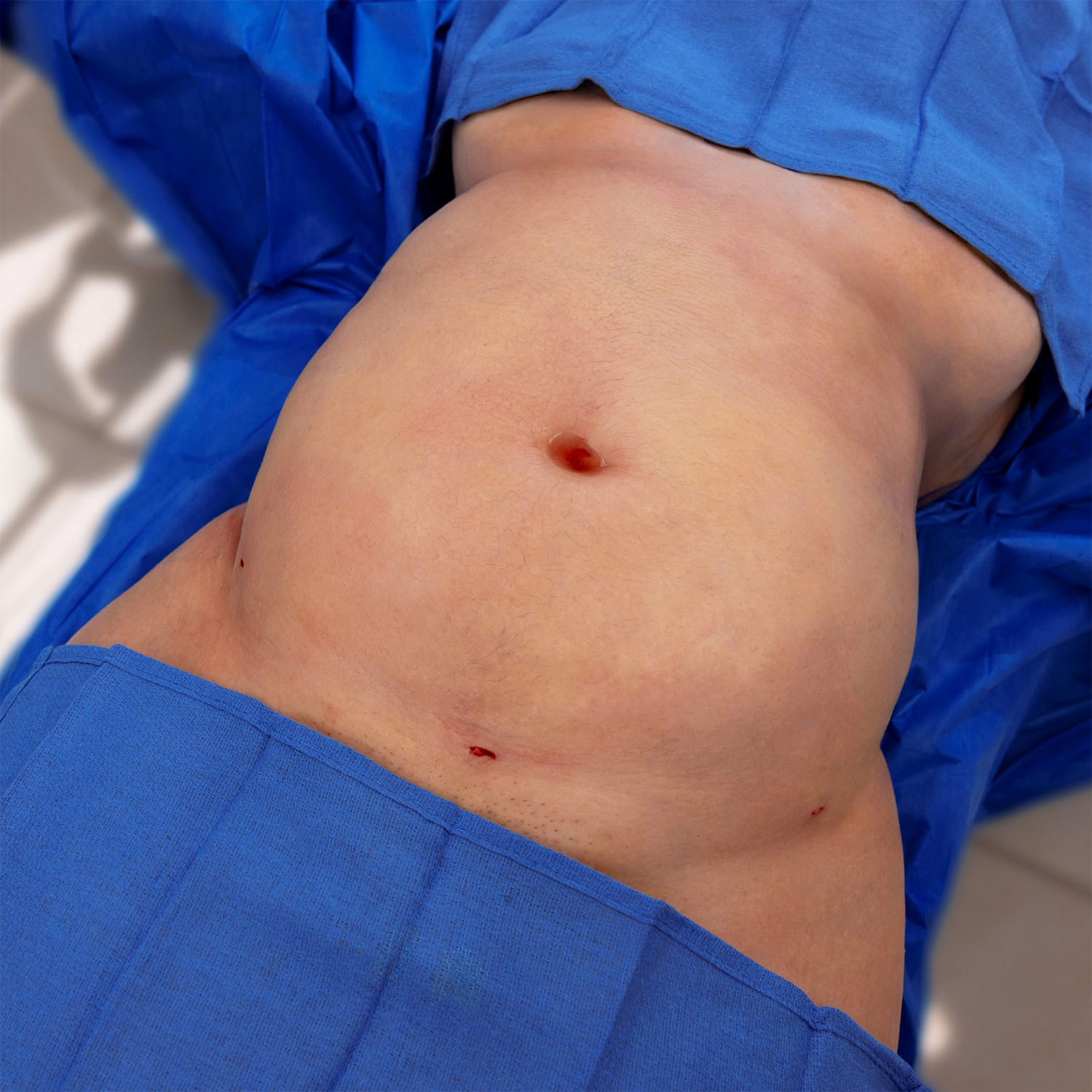 liposuction patient before