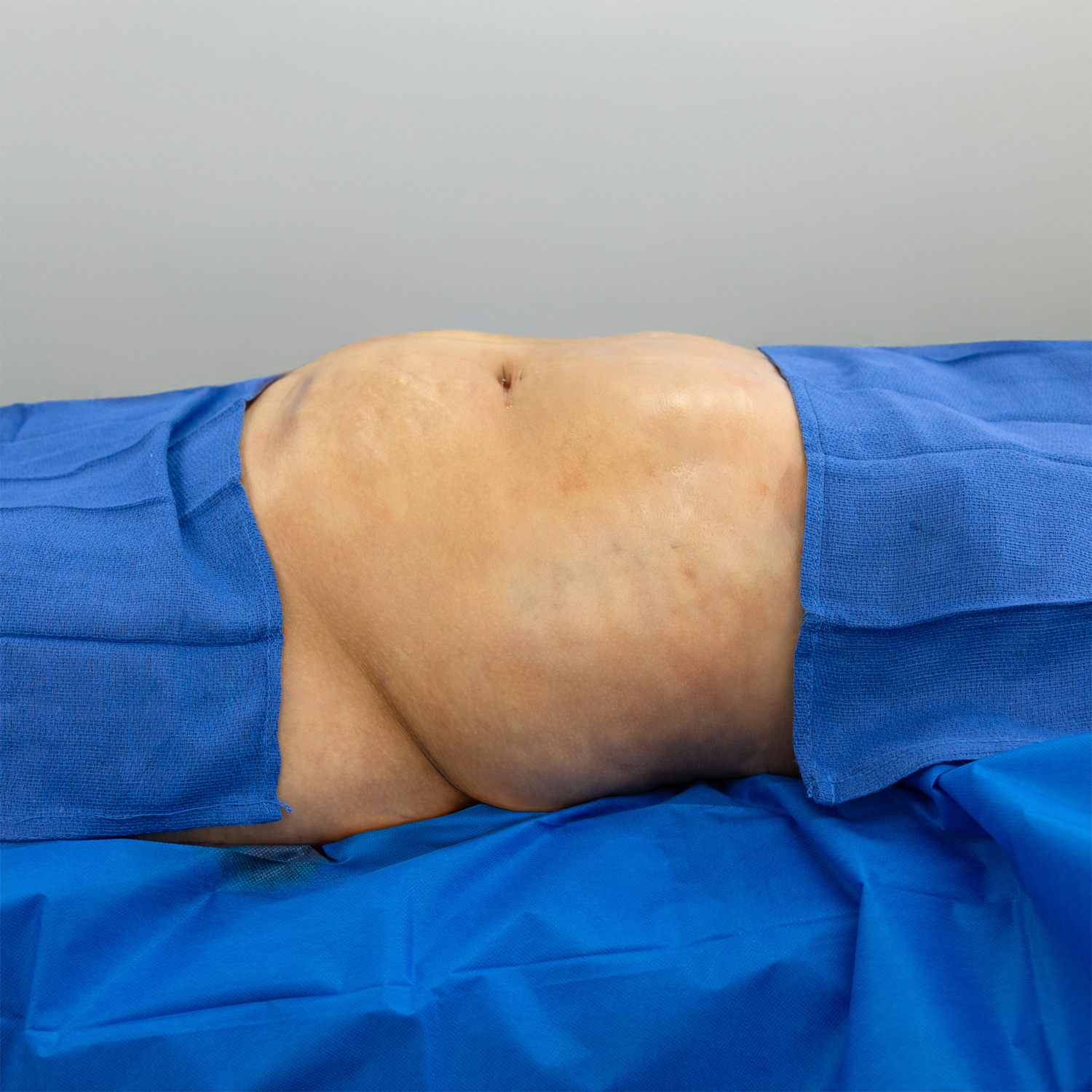 liposuction procedure before