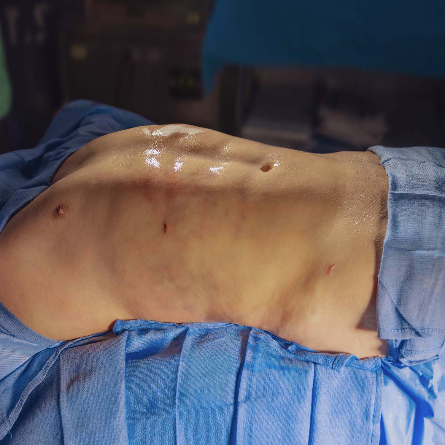 male liposuction after