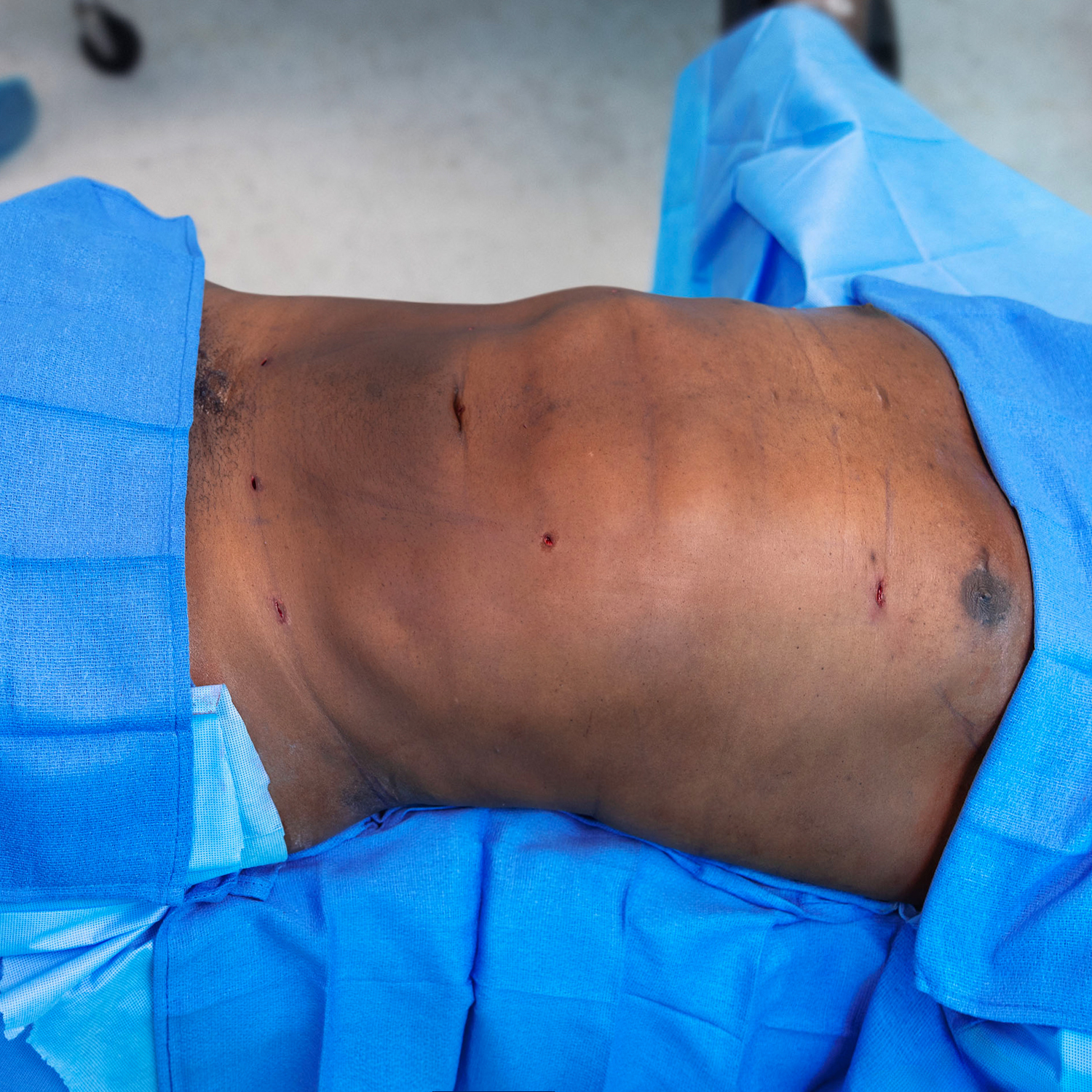 male liposuction after