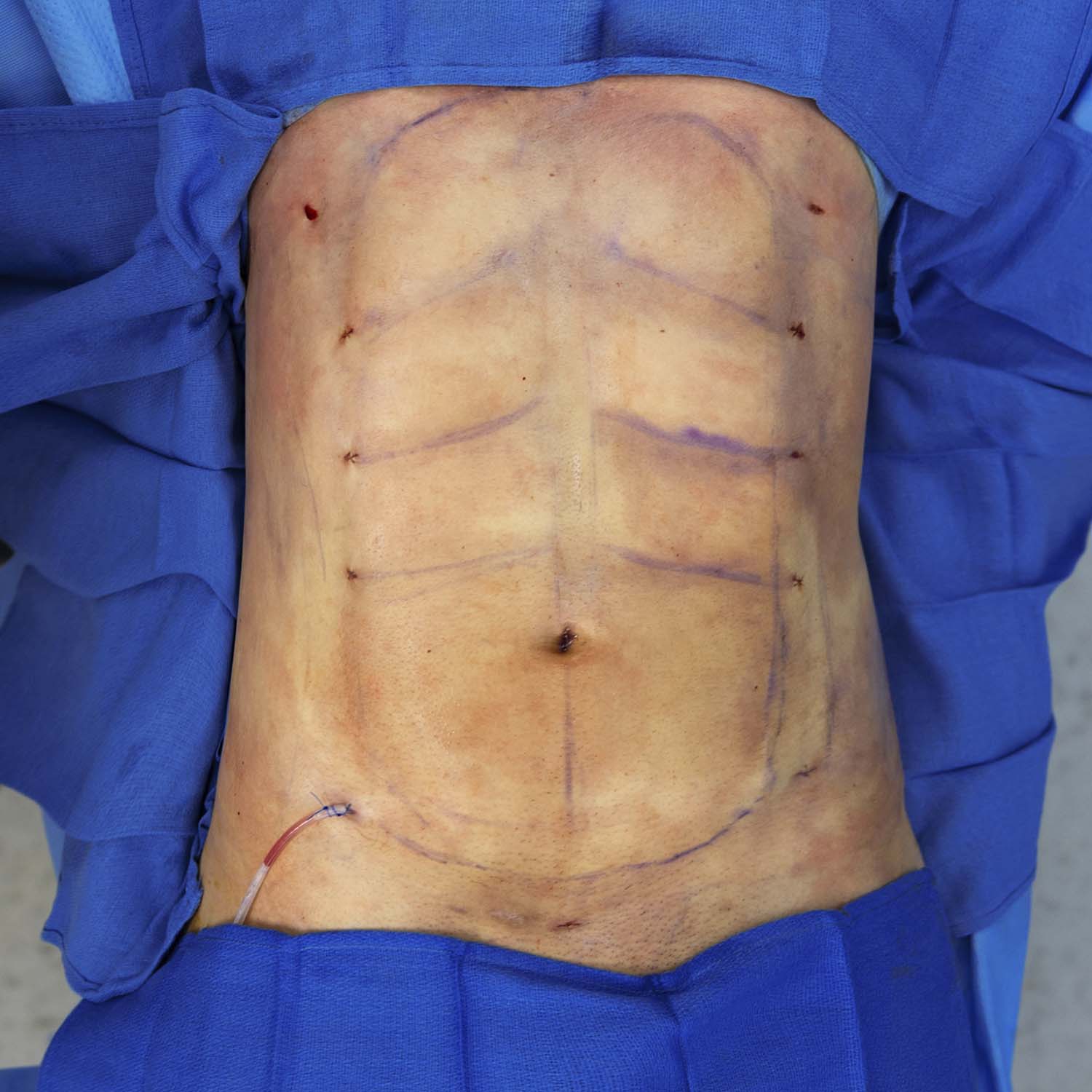 male liposuction by nosrati after