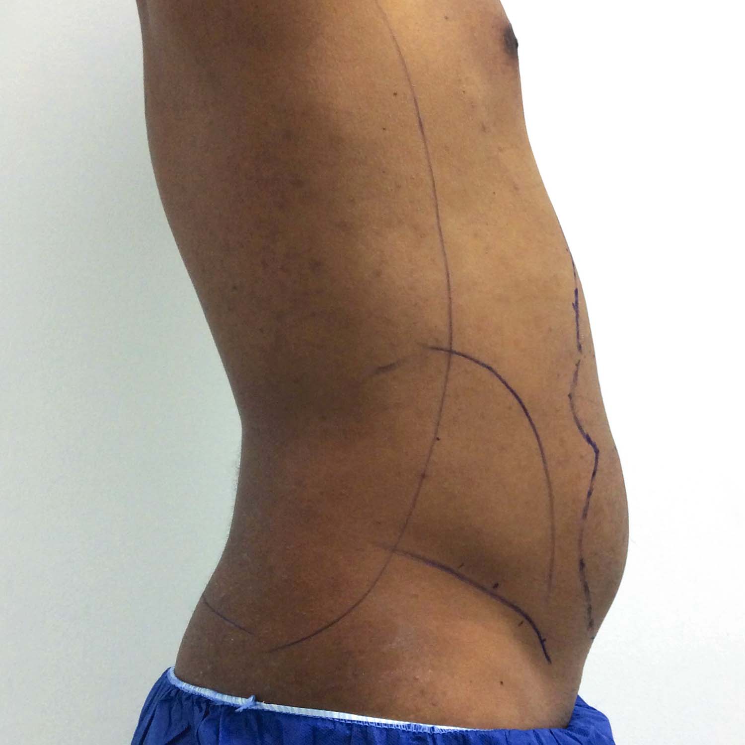 male patient by nosrati liposuction before