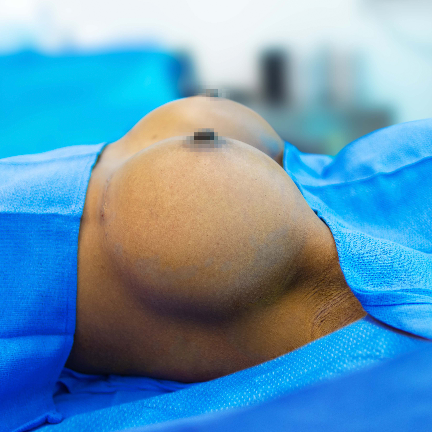 manny breast augmentation after