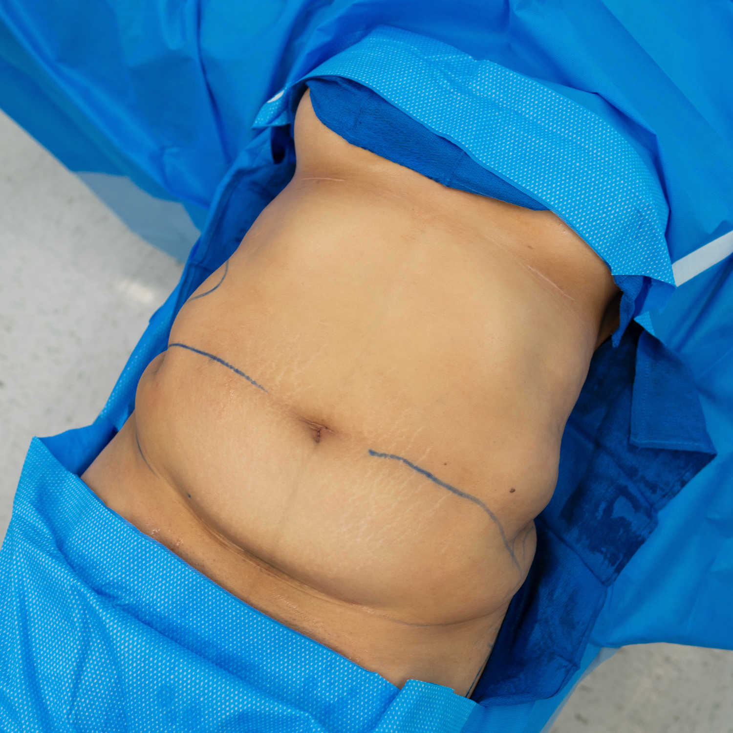 manny tummy tuck before