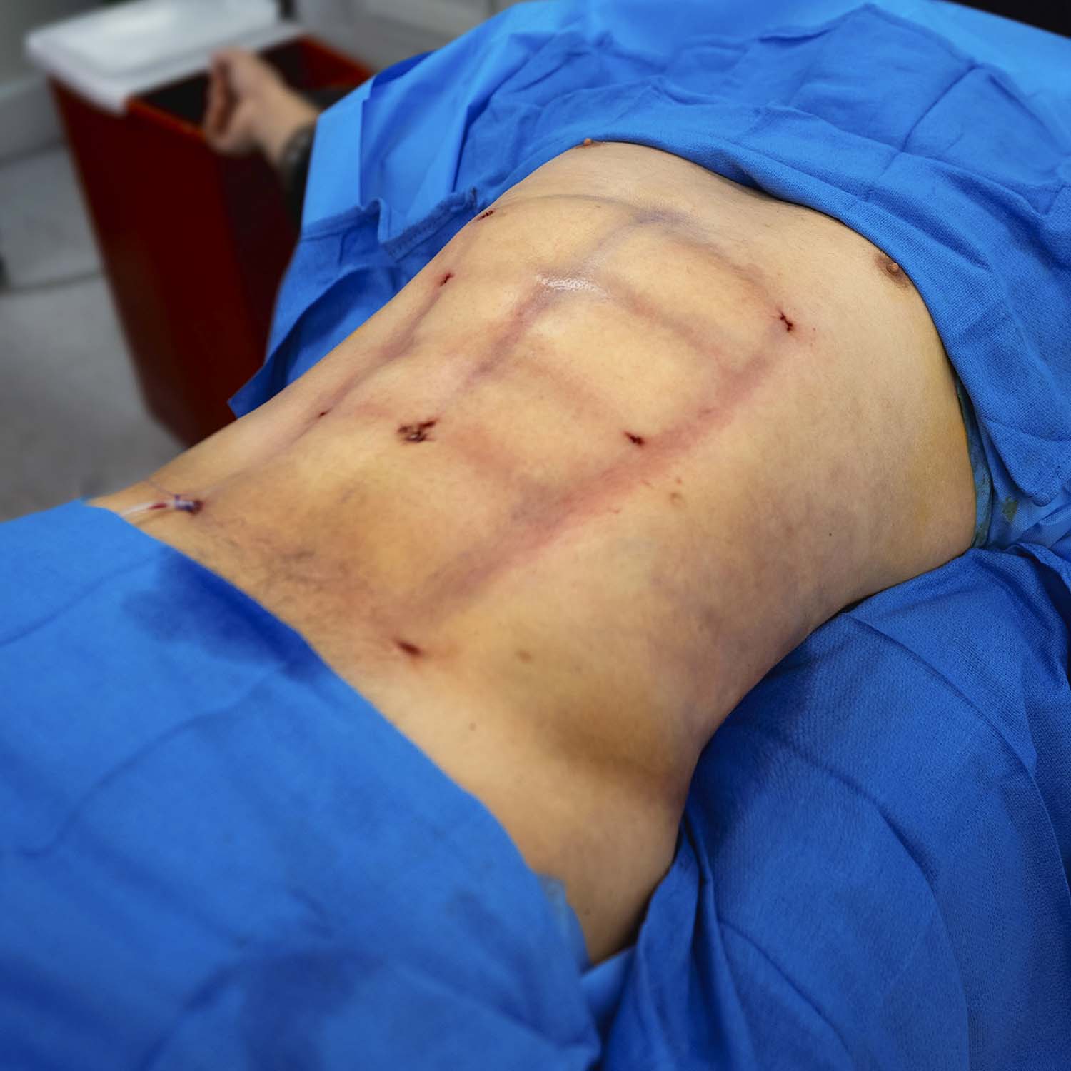 nosrati male patient liposuction after