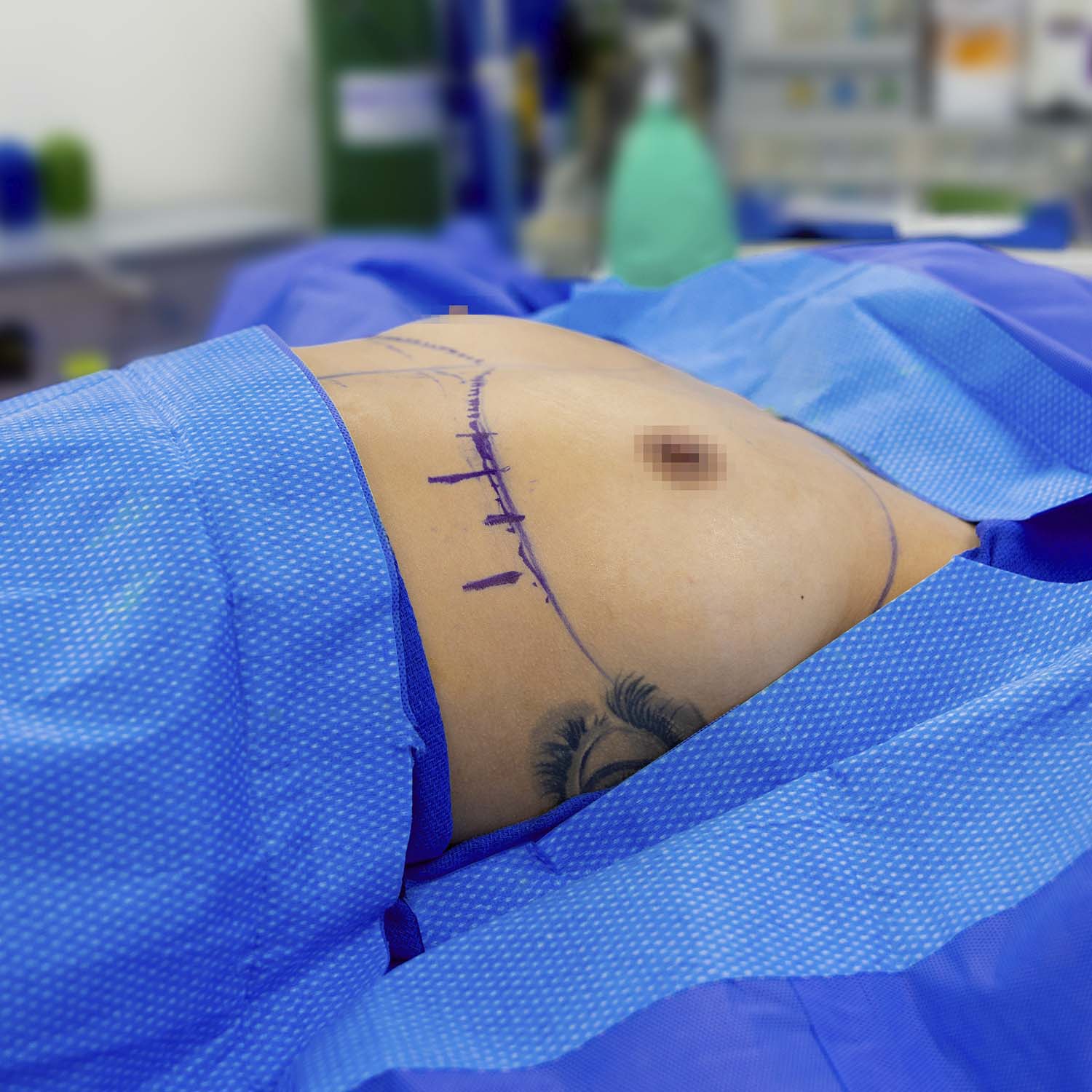 nosrati patient breast augmentation before