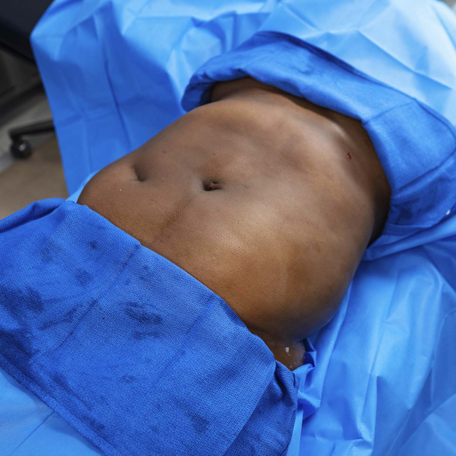 nosrati patient lipo before