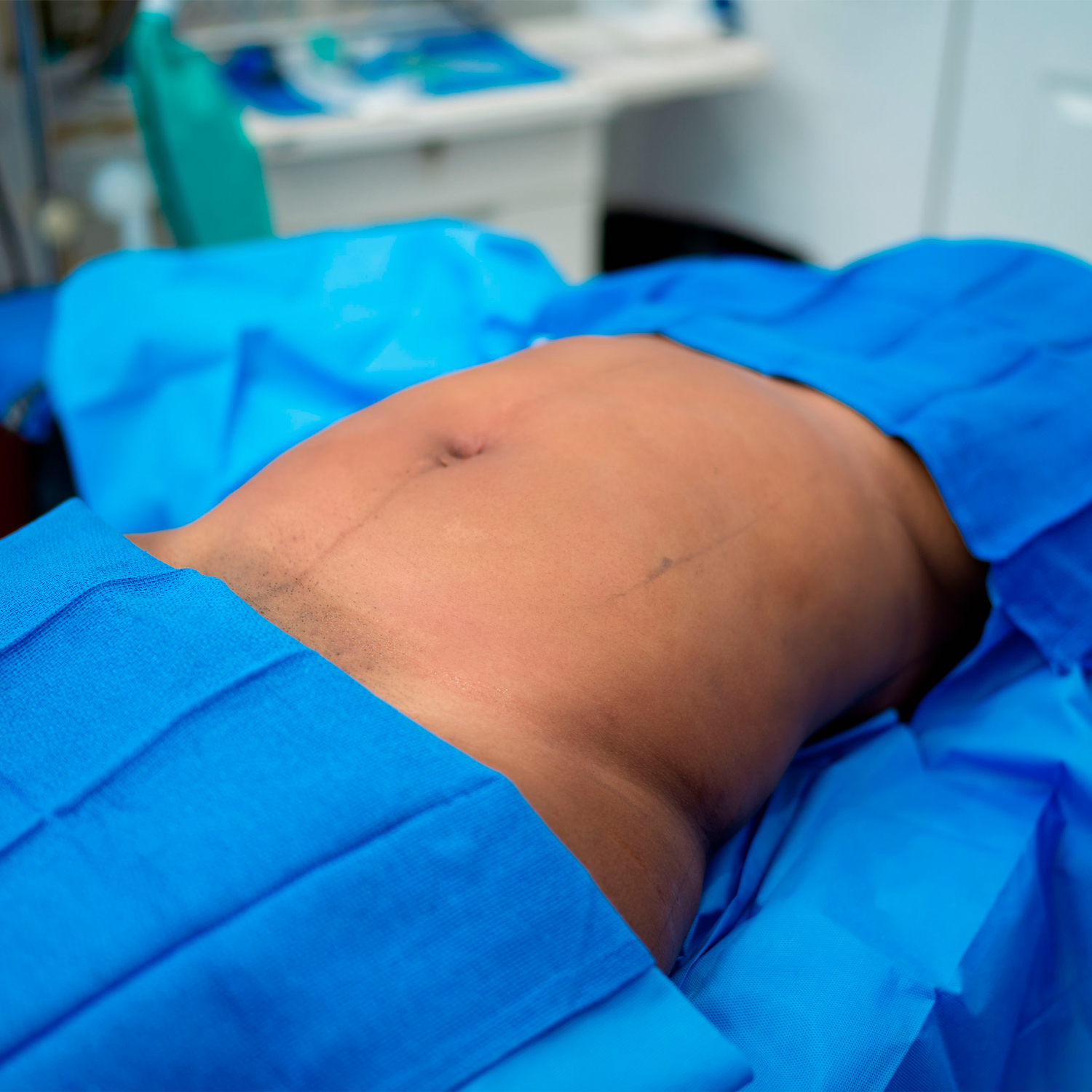 patient before liposuction from dr brewster