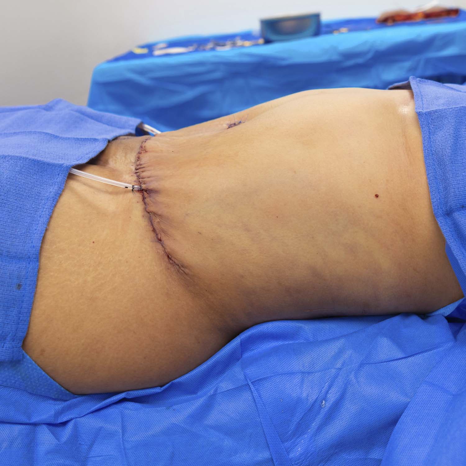 side view tummy tuck after