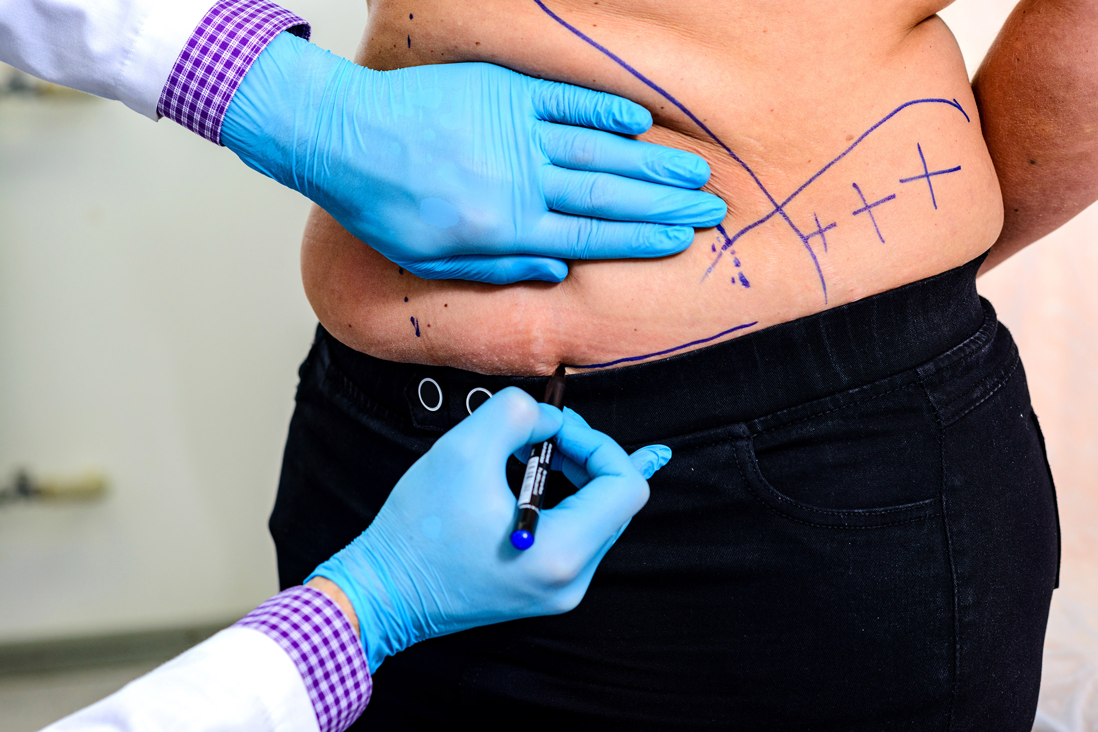 surgeon drawing tummy tuck surgery lines