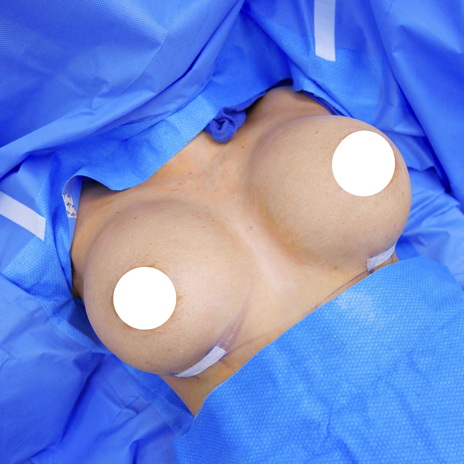 top view breast augmentation after