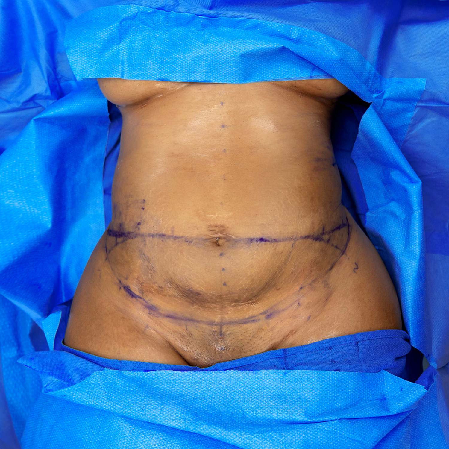 tummy tuck by jc alvarez before