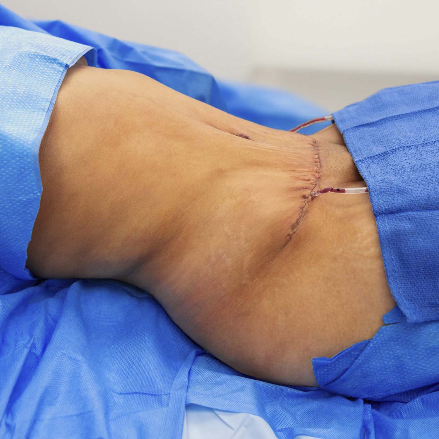 tummy tuck patient after