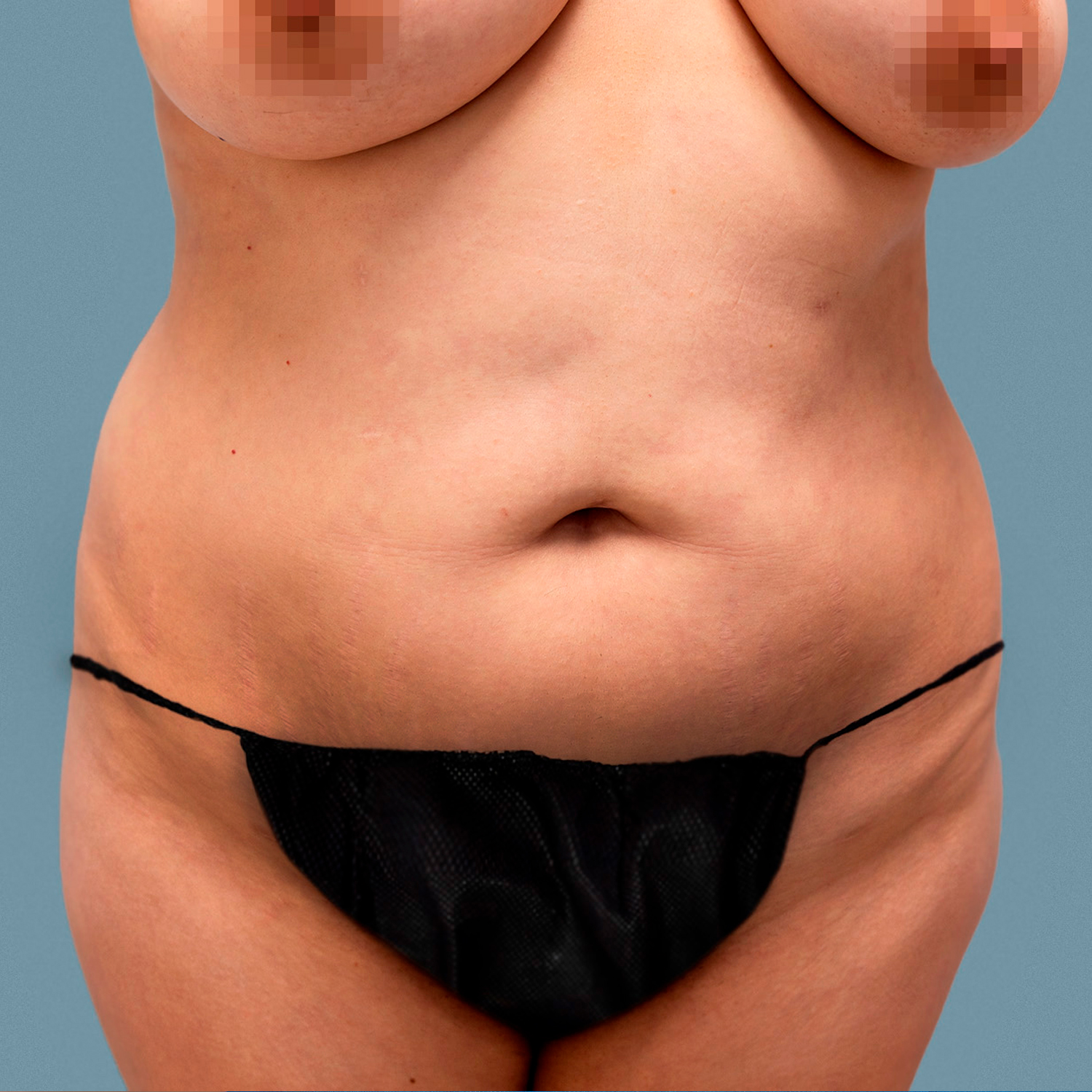 tummy tuck patient before