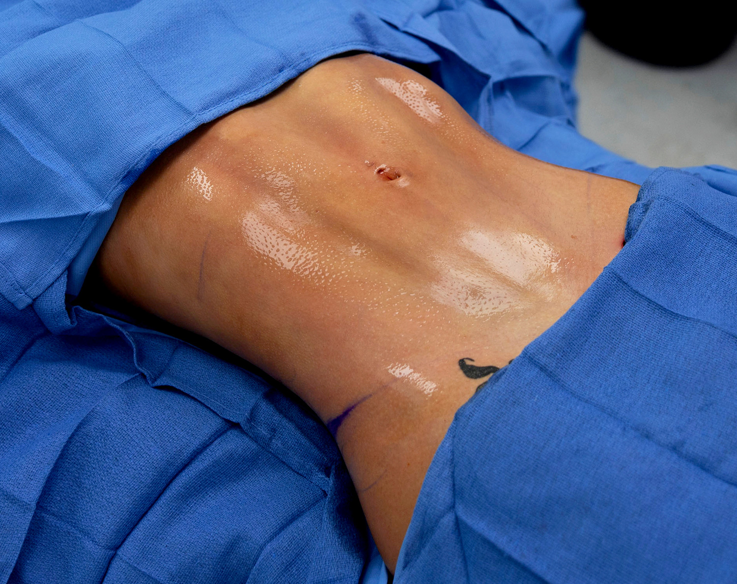 abdominal section after hd liposuction