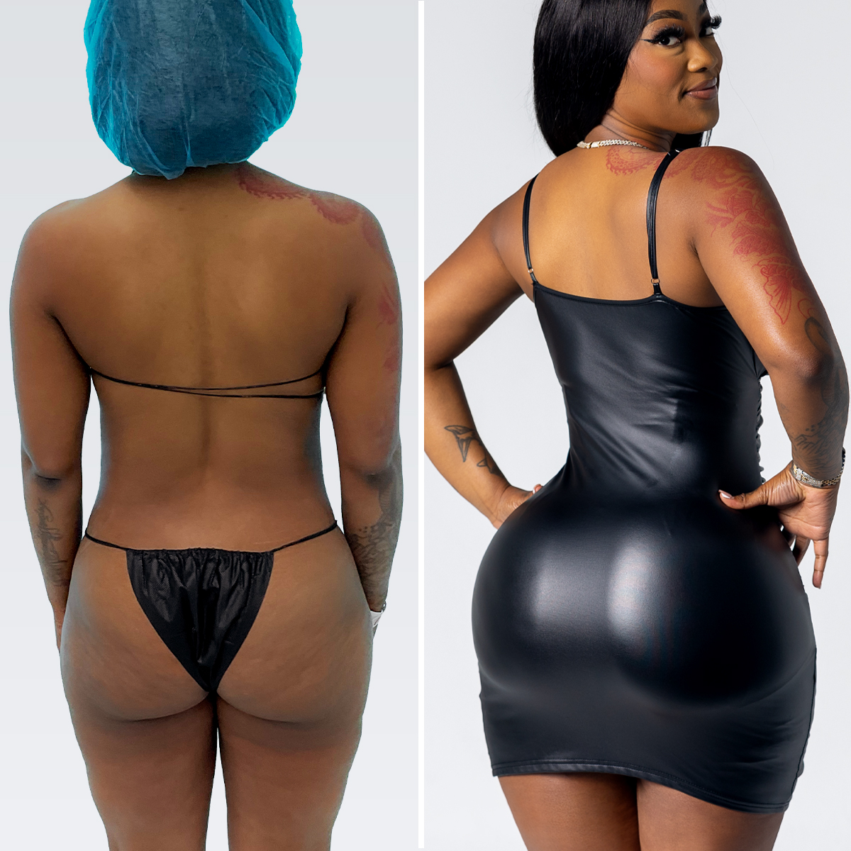 before and after brazilian butt lift patient results