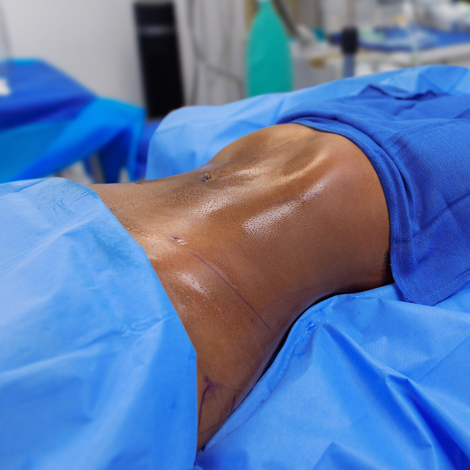 1-morales-lipo-after