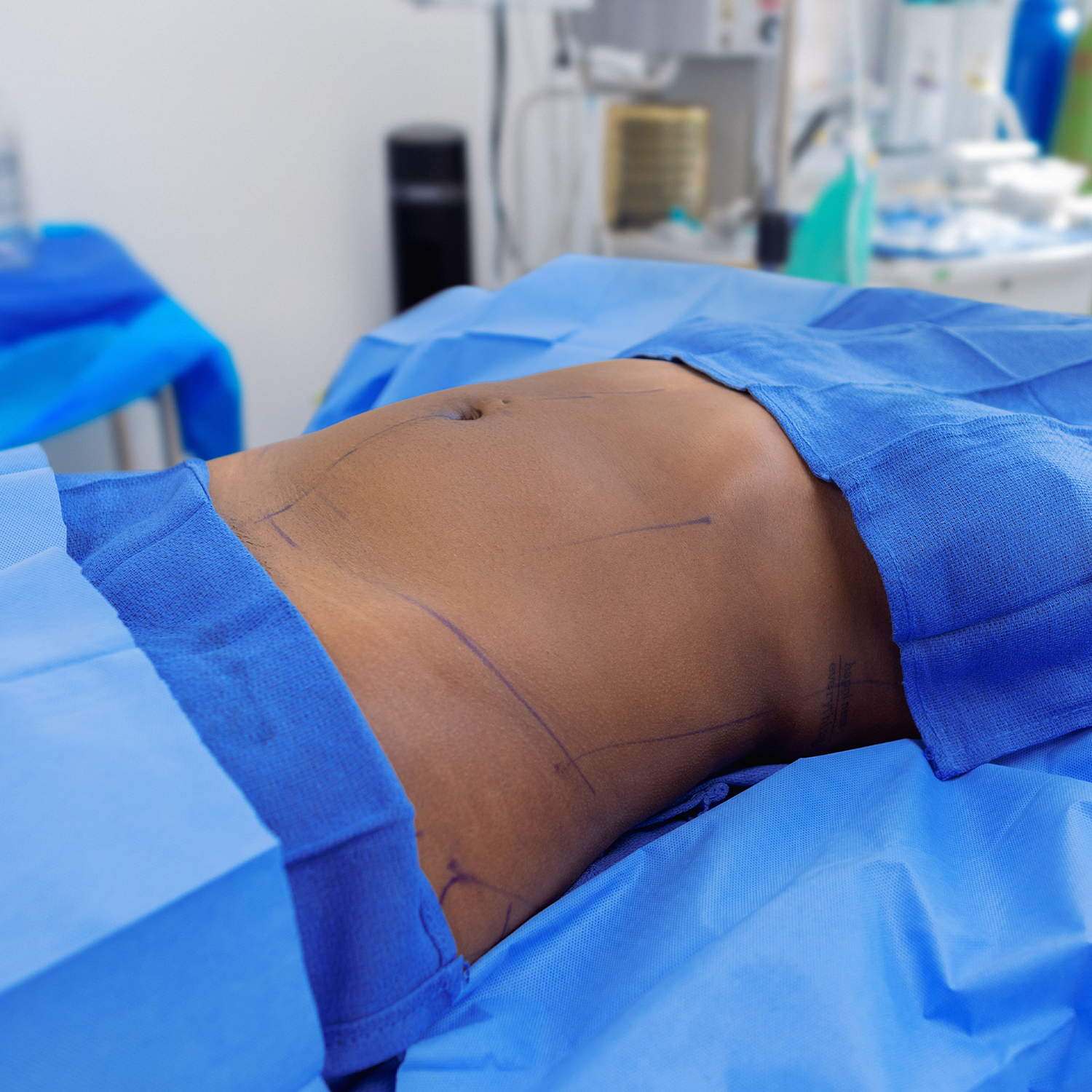 1-morales-lipo-before