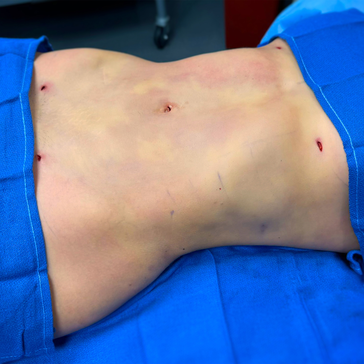 2-morales-lipo-after